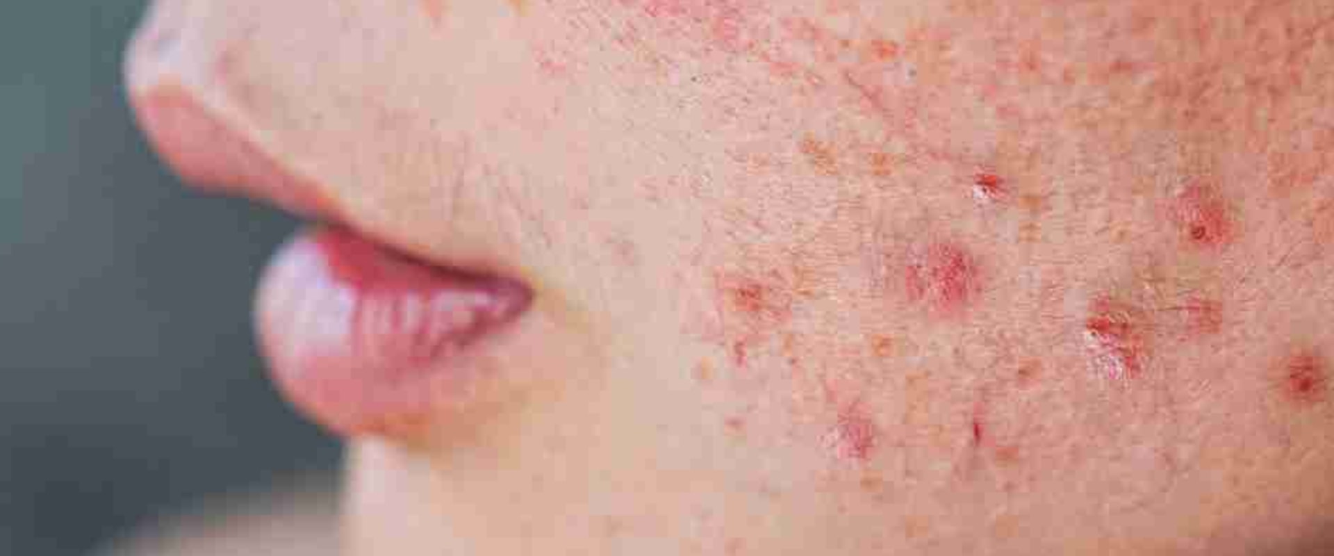 Understanding Hormonal Imbalances and Their Effects on Skin